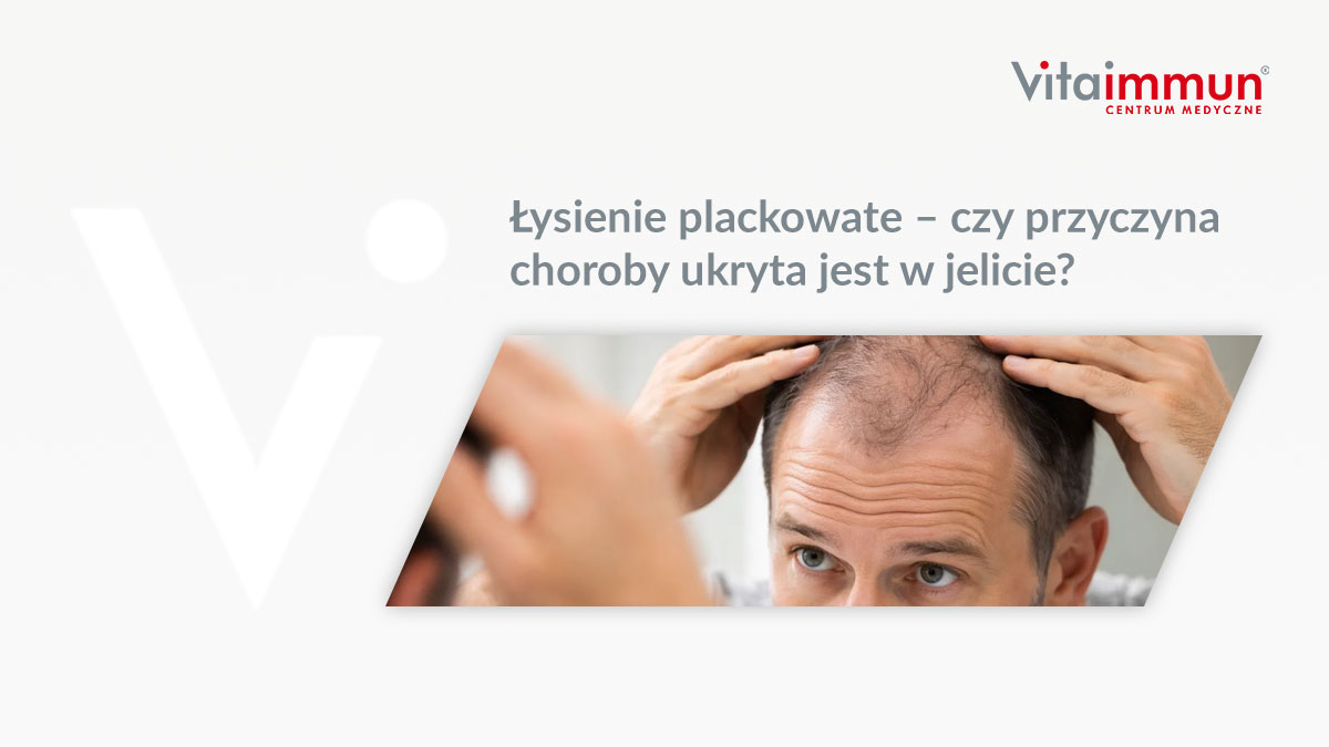 Łysienie plackowate – czy przyczyna choroby ukryta jest w jelicie?