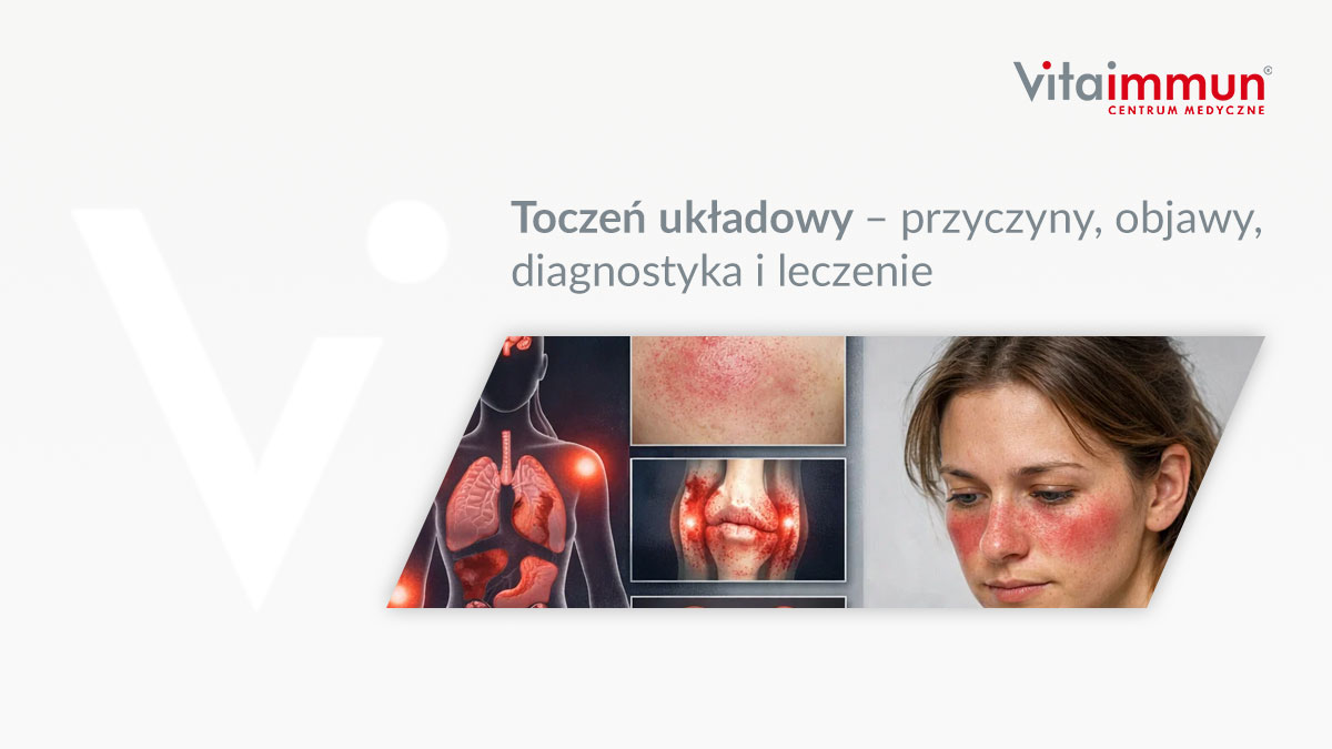 Toczeń układowy – przyczyny, objawy, diagnostyka i leczenie