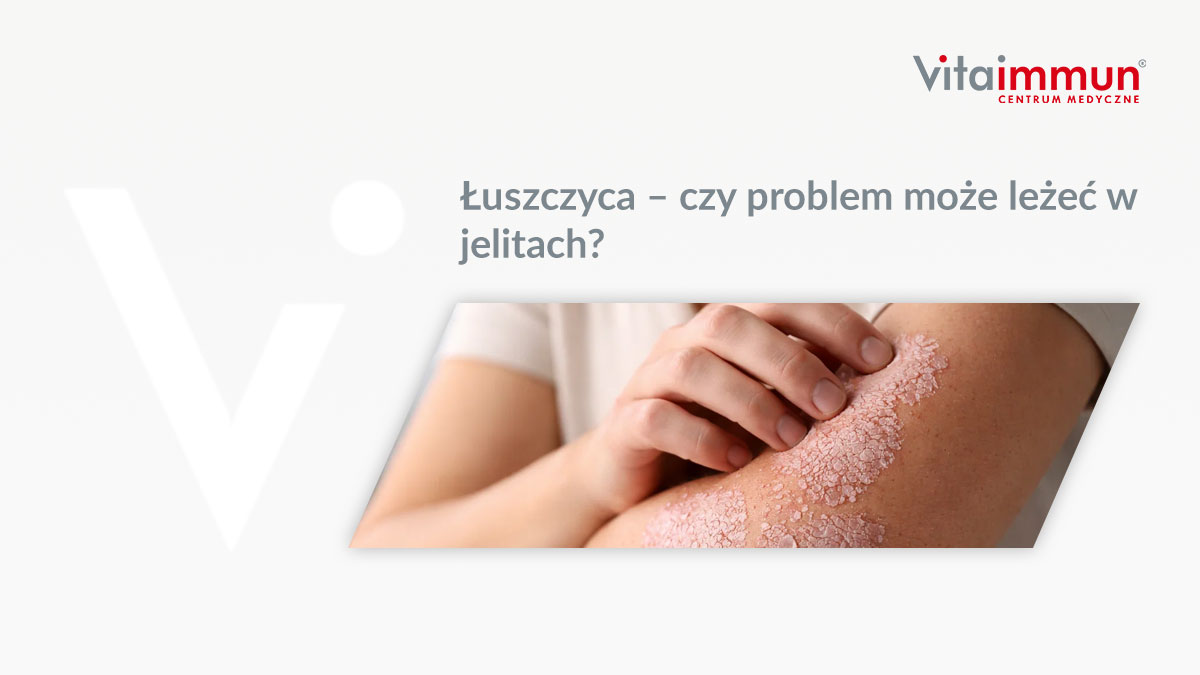 Łuszczyca – czy problem może leżeć w jelitach?